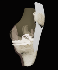  가상현실을 이용한  슬관절 MRI 3D 리모델링 